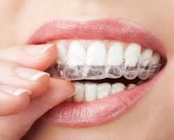 Invisalign Gullotta Orthodontics