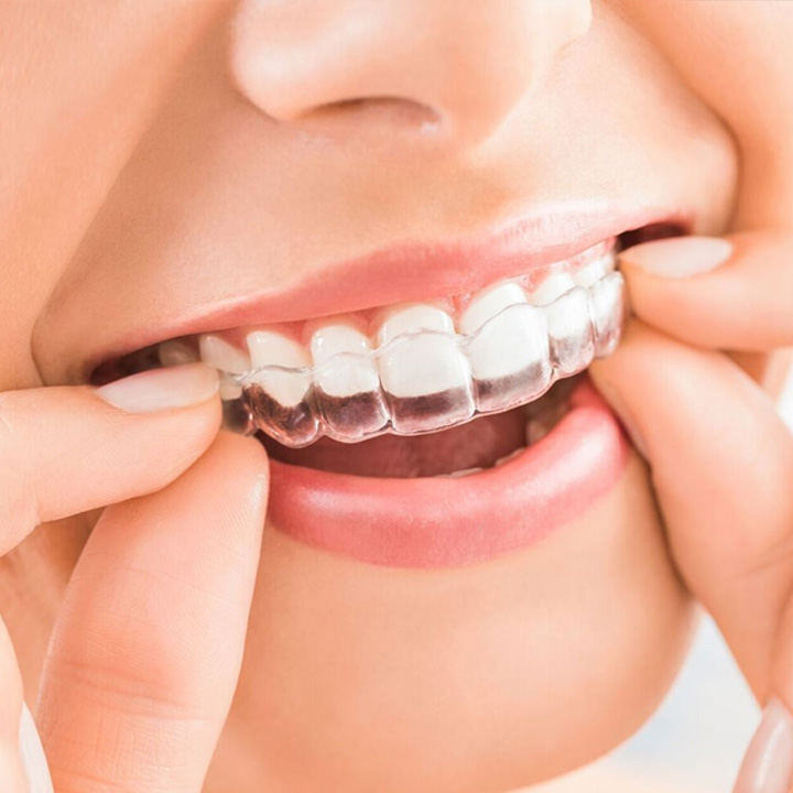 what is invisalign