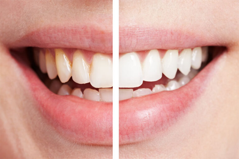 Dental Veneers Cost 1 768x512