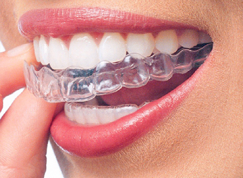 Invisalign