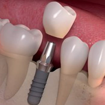 Dental implants