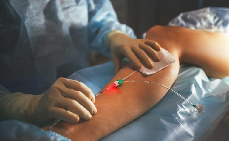 laser varicose veins 768x472