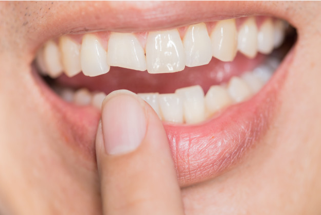 Cracked tooth2