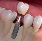dental implants 1